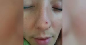 Не заживающая рана в носу