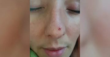 Не заживающая рана в носу Не заживающая рана в носу