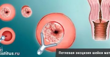 Конизация шейки матки петельным методом