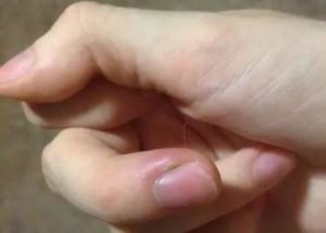 Зуд подушечек пальцев мизинцев, на обоих ногтях лунки, вытекает жидкость