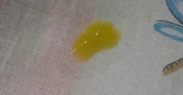 Выделения с носа жёлтые при аллергии Выделения с носа жёлтые при аллергии