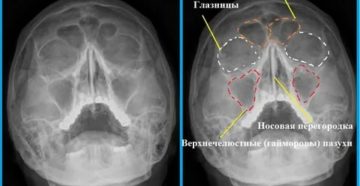 Расшифровка снимка носа