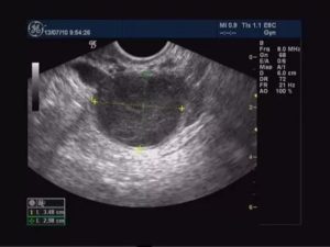 Киста эндометриоидная по УЗИ