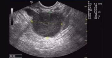 Киста эндометриоидная по УЗИ