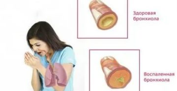 Не проходит кашель 2 месяца, антибиотики не помогли Не проходит кашель 2 месяца, антибиотики не помогли