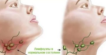 Постоянно увеличиваются лимфоузлы анализы