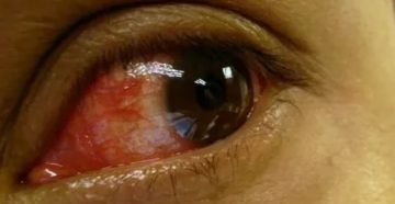 Конъюнктивит, фликтена