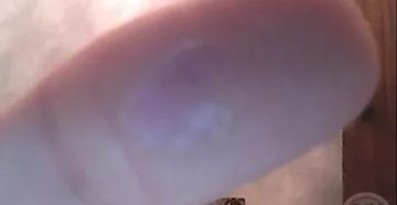 Мозоль на головке Мозоль на головке