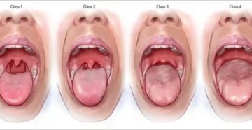 Что то появилось на небном язычке