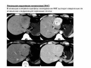 Фнг и гемангиомы печени
