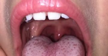 Болит горло и на языке появились болячки Болит горло и на языке появились болячки