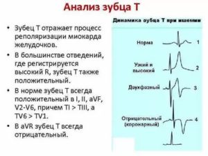 Высокий зубец Т на ЭКГ