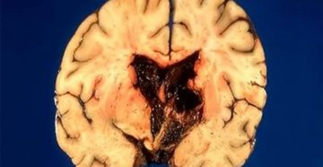 Смерть от геморрагического инсульта Смерть от геморрагического инсульта