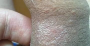 Сухое белое пятно под уздечкой члена