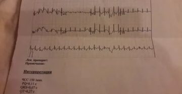 Заключение ЭКГ у годовалого ребенка