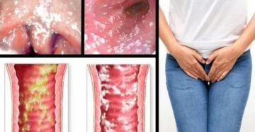 Молочница после отмены ок