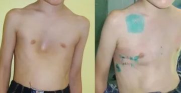 Деформация мечевидного отростка (возможно ли удалить)