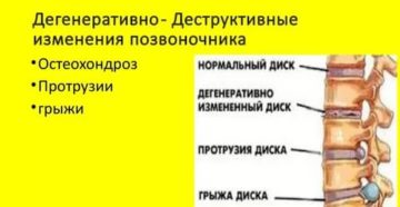 Дегенеративно-дистрофические изменения