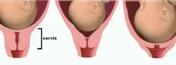 Короткая шейка матки в 16 недель