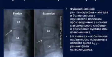 Функциональный блок на рентгенограмме