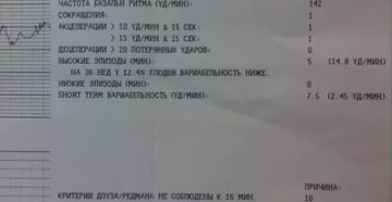 Расшифровка КТГ, не соблюдены критерии Доуз-Редмана