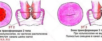 Кольпоскопия. Зт тип 2