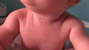 Красная шея у ребенка в 3, 5 месяцев