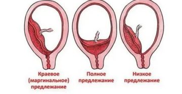 Краевое прикрепление плаценты