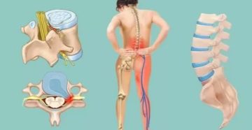 Протрузия и беременность Протрузия и беременность