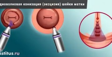 Радиоволновая конизация