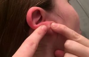 Красная шишка на мочке уха сзади