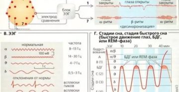 Расшифровка ЭЭГ для ребенка