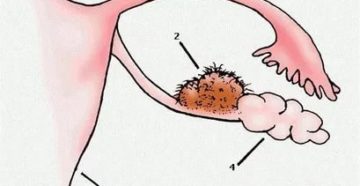 Постоянное появление кисты яичника