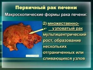 Подозрение на первичный рак печени