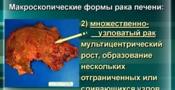 Подозрение на первичный рак печени