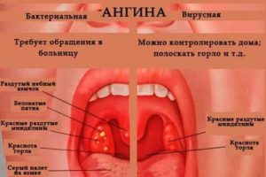Возможно ли появление ОРВИ после ангины?