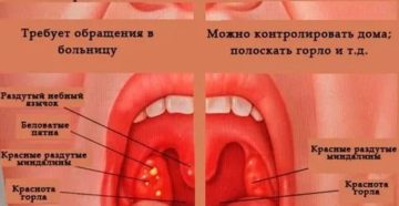 Возможно ли появление ОРВИ после ангины?