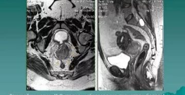 Рак шейки матки. Рецедив. МРТ малого таза. Есть ли опухоль?