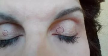 Красный прыщик на верхнем веке Красный прыщик на верхнем веке