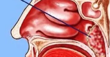Что означает сужение просвета носоглотки до1/2