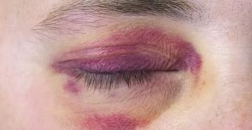 Ссадина возле глаза чем намазать