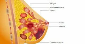 Фиброаденома или жировая долька