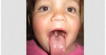 Второй язычок у ребенка