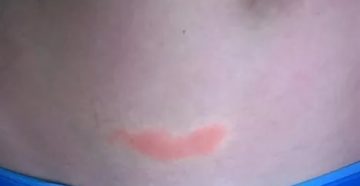 Пятна ниже пупка