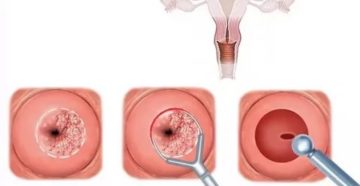 Мастурбация после биопсии шейки матки