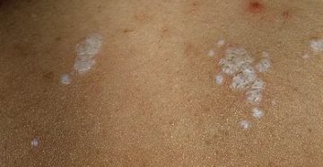 Пятно после болячки Пятно после болячки