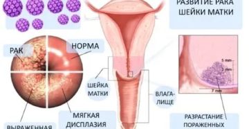 Можно ли беременеть при ВПЧ 16?