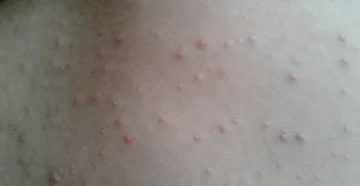 Высыпание на коже, зуд, непонятный прыщик на животе, фото прикладываю