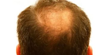 Залысина на затылке