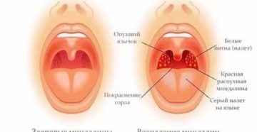 Красные точки на миндалинах с белым налетом